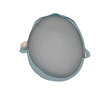 Brachycephaly before correction top view