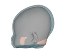 Combination brachycephaly and plagiocephaly side view