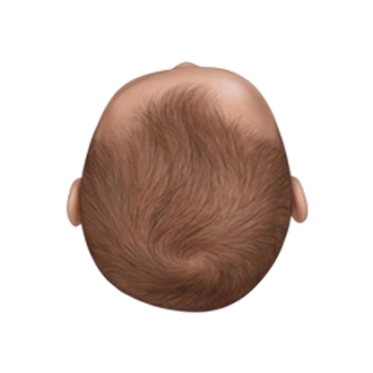 Moderate plagiocephaly